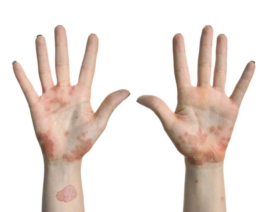 Psoriasis of the hands